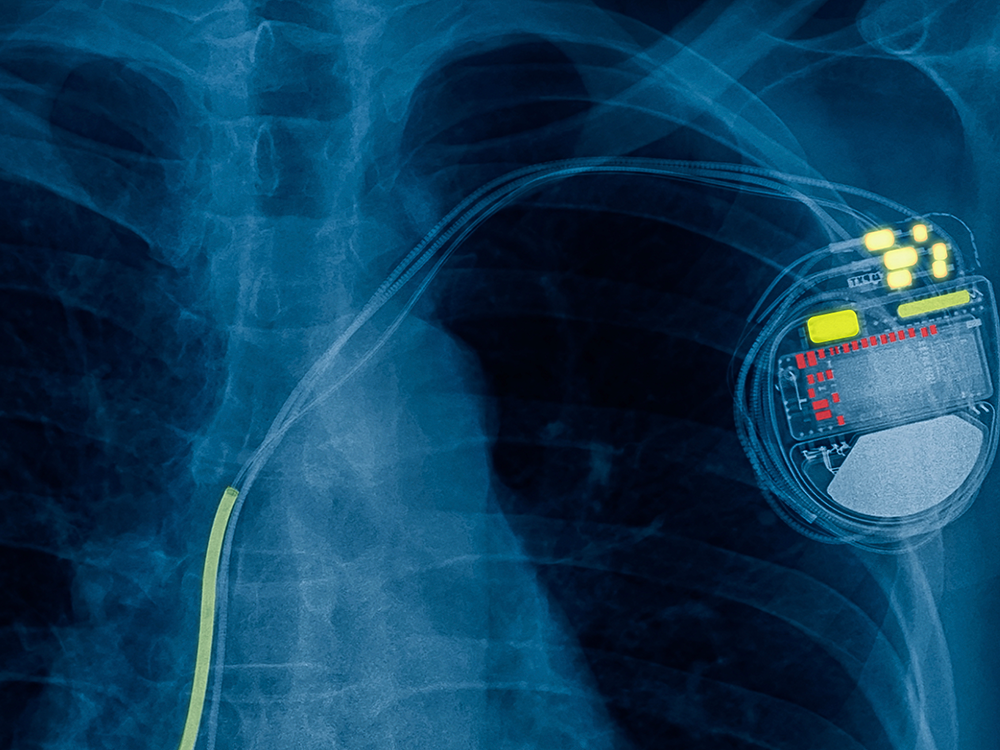 X-ray of pacemaker