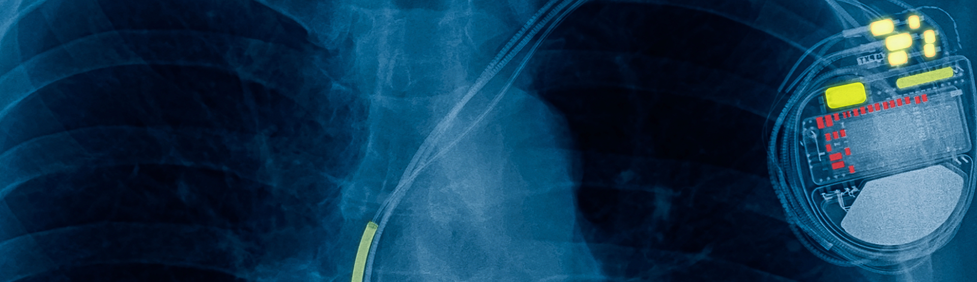 X-ray of pacemaker